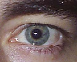 freckle on eyelid